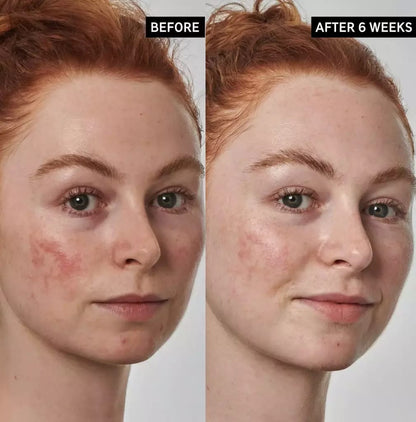 Serum Acido Azelaico NINELESS