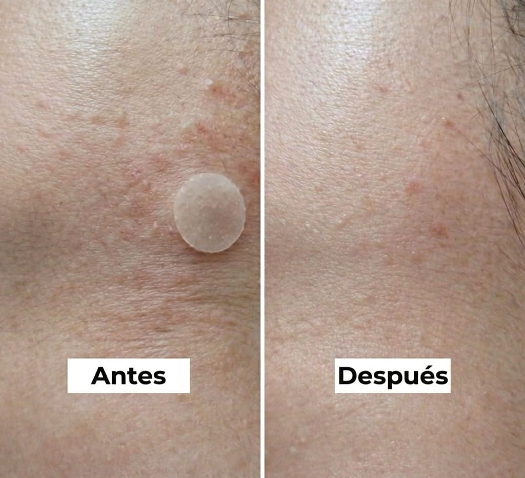 Nineless Crema Ácido Azeláico 10,000 ppm Antiacné y Antimancha