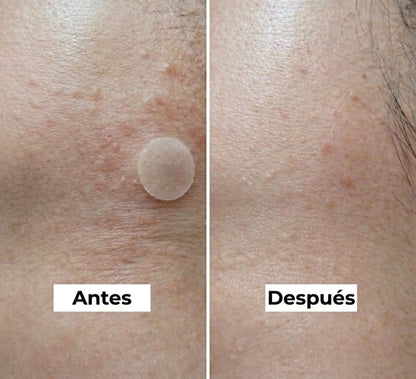 Nineless Crema Ácido Azeláico 10,000 ppm Antiacné y Antimancha